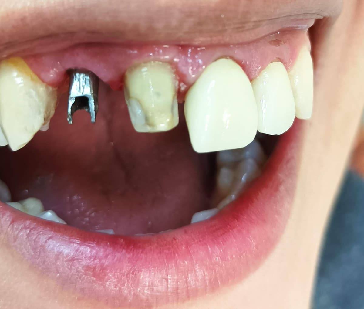Perno colado colocado en una pieza dental, listo para recibir la corona
