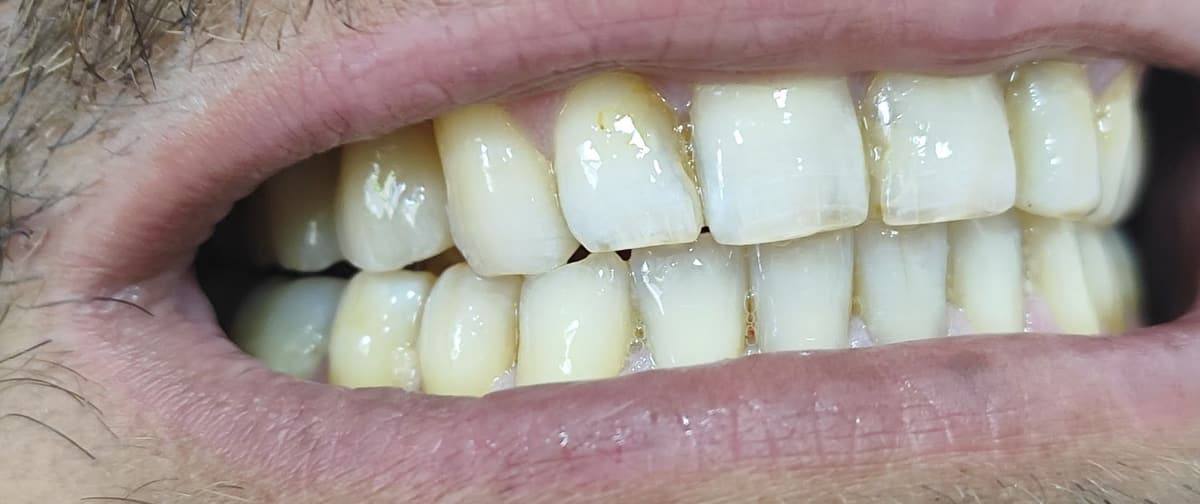 Sonrisa con coronas dentales terminadas