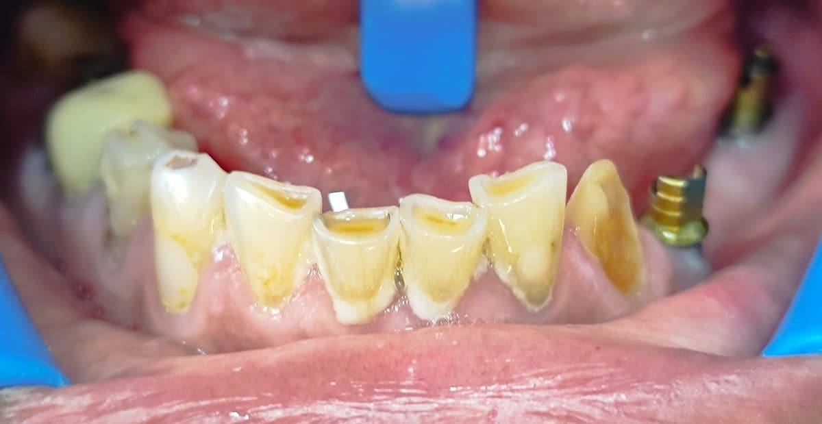Dientes inferiores con desgaste severo por bruxismo