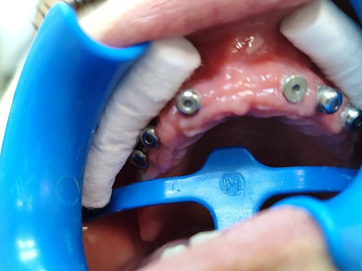 Implantes dentales colocados en el maxilar superior, vistos con separador de labios