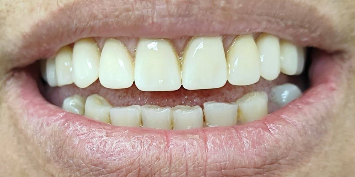 Sonrisa con prótesis dental fija terminada