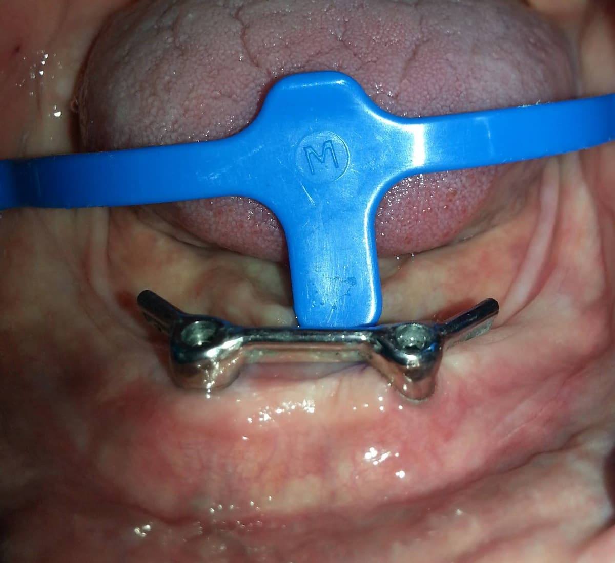 Opción sobre barra: barra metálica que une 2 implantes, colocada en el maxilar inferior