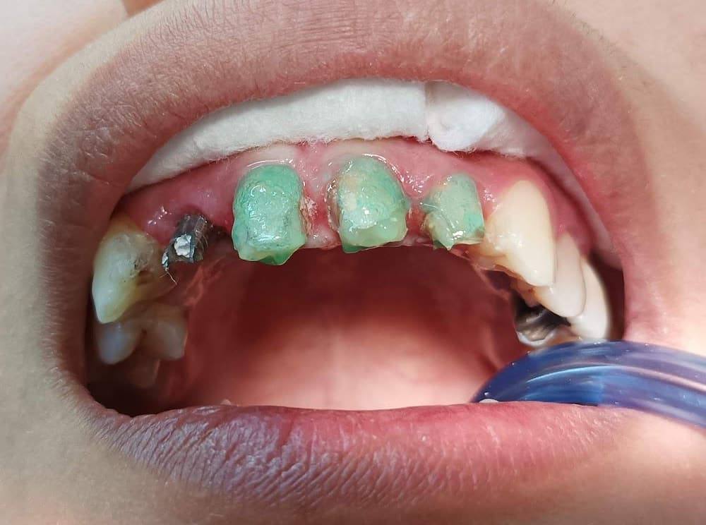 Piezas dentales preparadas con pernos antes de colocar las coronas