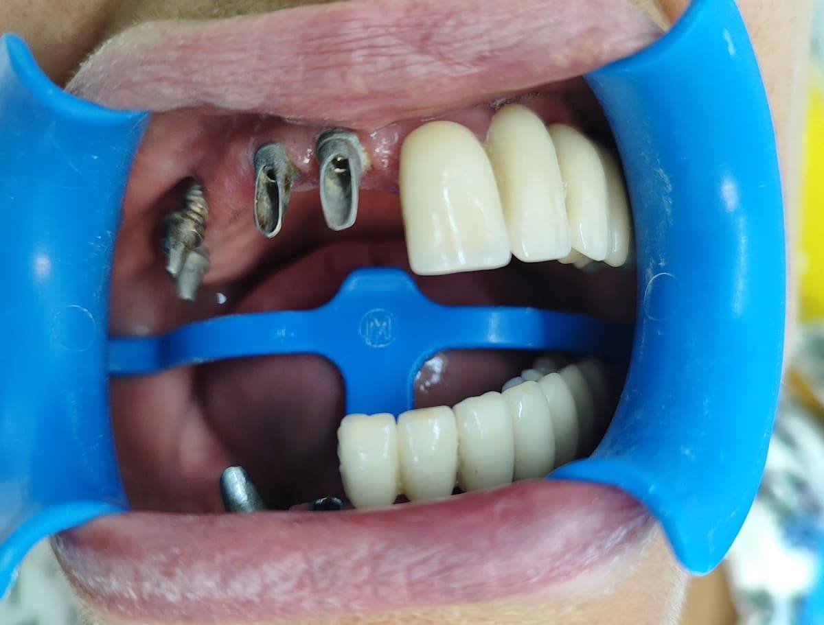 Pilares sobre implantes junto a coronas y puente definitivos en boca