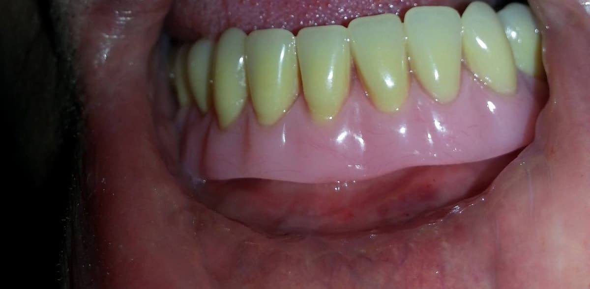 Prótesis dental inferior colocada en boca