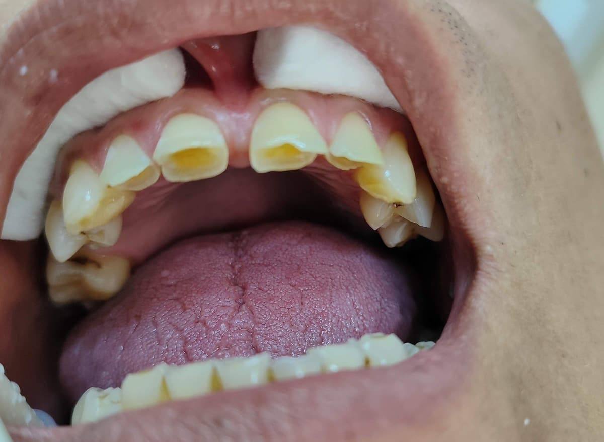 Dientes superiores gastados y fracturados por bruxismo