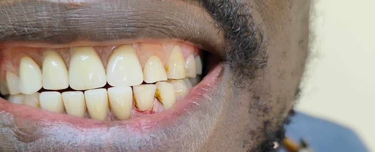 Sonrisa con la prótesis flexible colocada