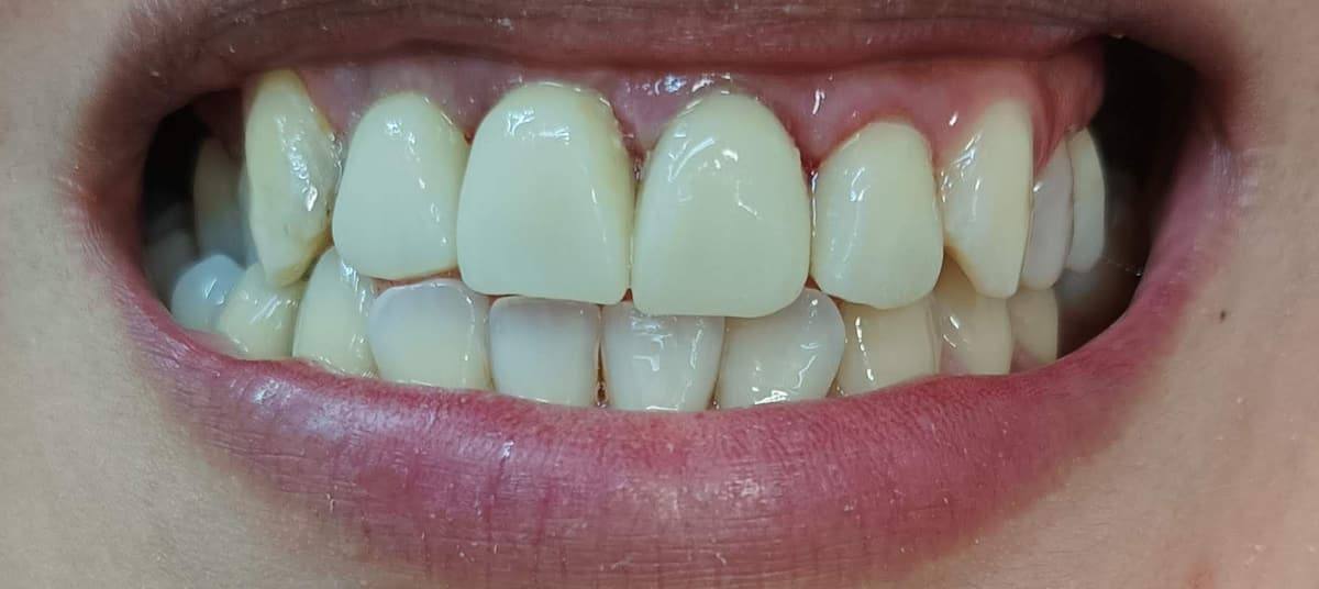 Sonrisa con coronas dentales en el sector anterior