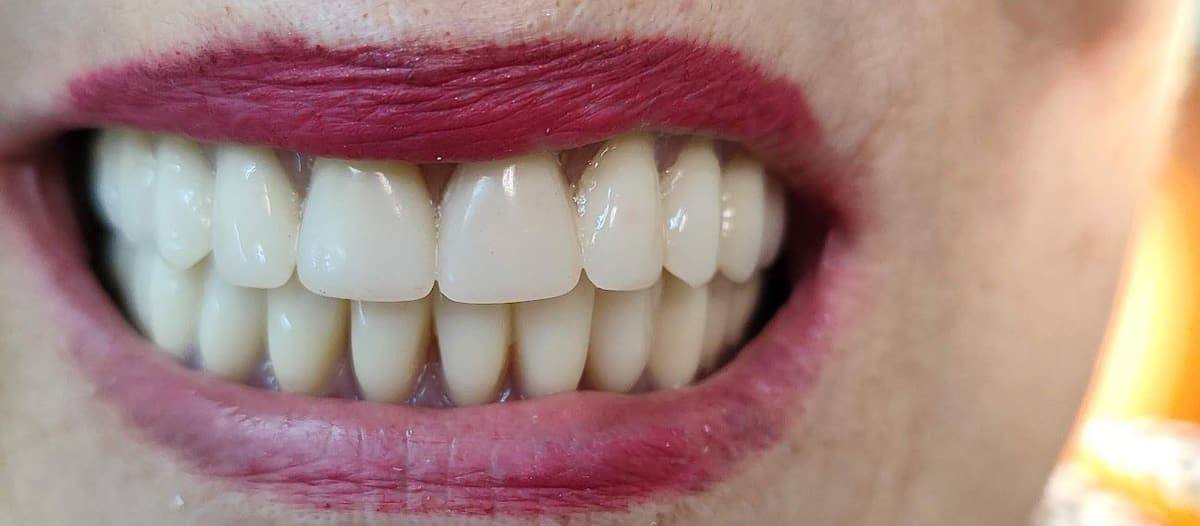 Sonrisa con prótesis dentales completas superior e inferior