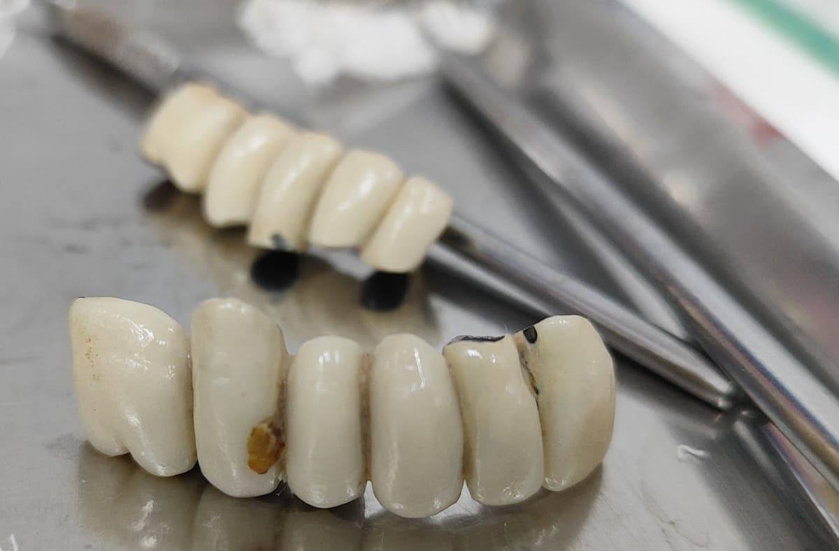 Puentes de rehabilitación completa sobre implantes, listos para colocar